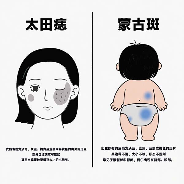 <strong>太田痣和蒙古斑有什么区别？怎么区分？</strong>