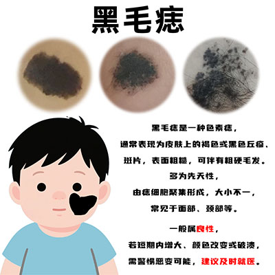 <strong>胎记解析丨黑毛痣和兽皮痣是一回事吗？哪个更严重？</strong>