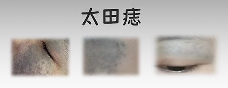 <strong>健康解答丨太田痣术后需要防晒吗？多久能恢复正常？</strong>