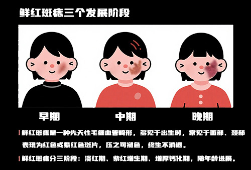 <strong>【早知道】孩子额头的鲜红斑痣会扩散到眼睛！医生：3个月内是黄金期！</strong>