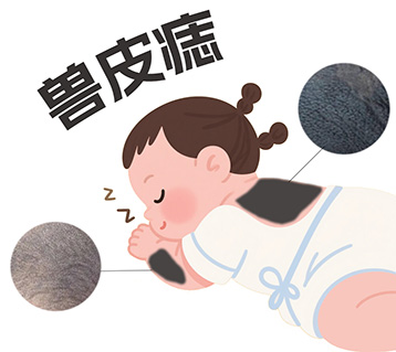 <strong>【康复追踪】兽皮痣切除后会留疤吗？怎么护理减少疤痕？</strong>