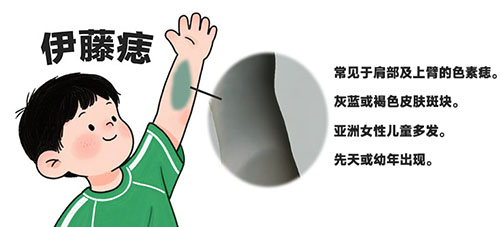【伊藤痣也可能伴发其他问题！】 罕见综合征的知晓