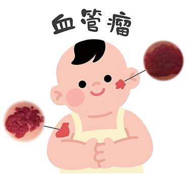 血管瘤是什么原因引起的？孕期哪里没注意？