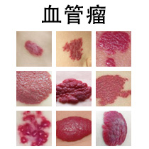 婴儿血管瘤会自己消退吗？消退后会不会留痕迹？