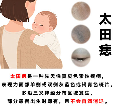 皮肤医疗动态：皮肤上有太田痣好治疗吗？