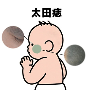 南京胎记医院排名：太田痣不治疗的影响
